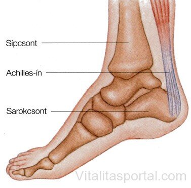 Az Achilles-ín gyulladása (tendinitisz)