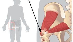 hogyan kell kezelni a láb arthrosisát keresztcsonti gerinc osteochondrosisának kezelése