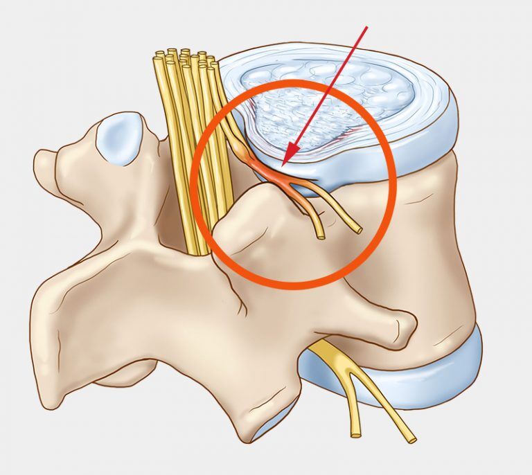 zsibbadt fájdalom a gerincben fájdalomcsillapítók a térd osteoarthritisére