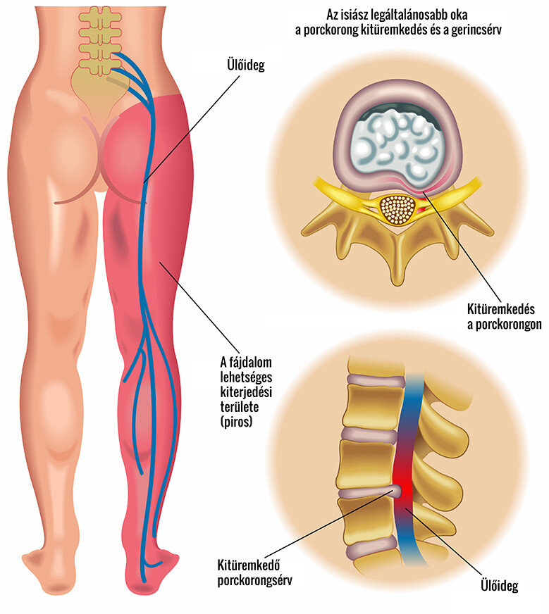 fájdalom és a csípőízület korlátozott mozgékonysága)